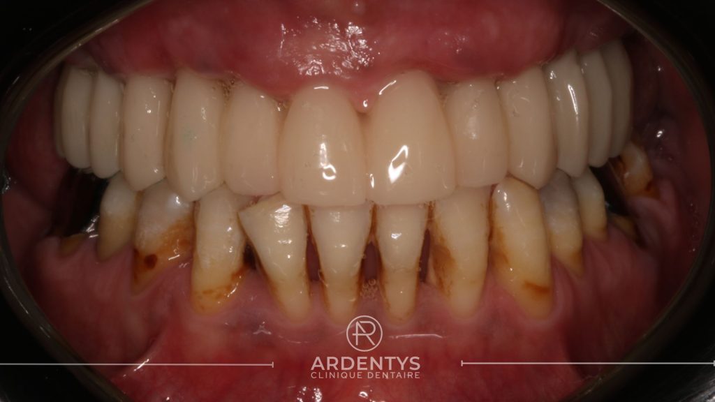 Réhabilitation complète uni maxillaire