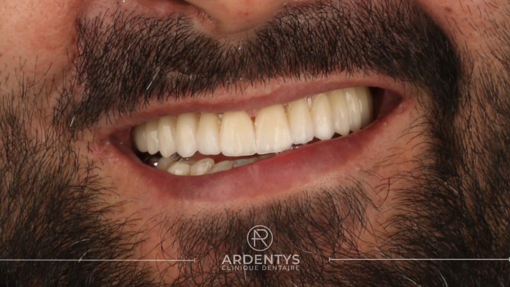 Réhabilitation complète uni maxillaire