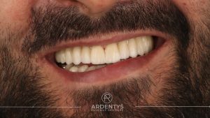 Réhabilitation complète uni maxillaire