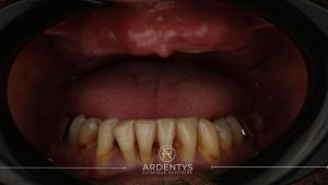 Réhabilitation complète uni maxillaire