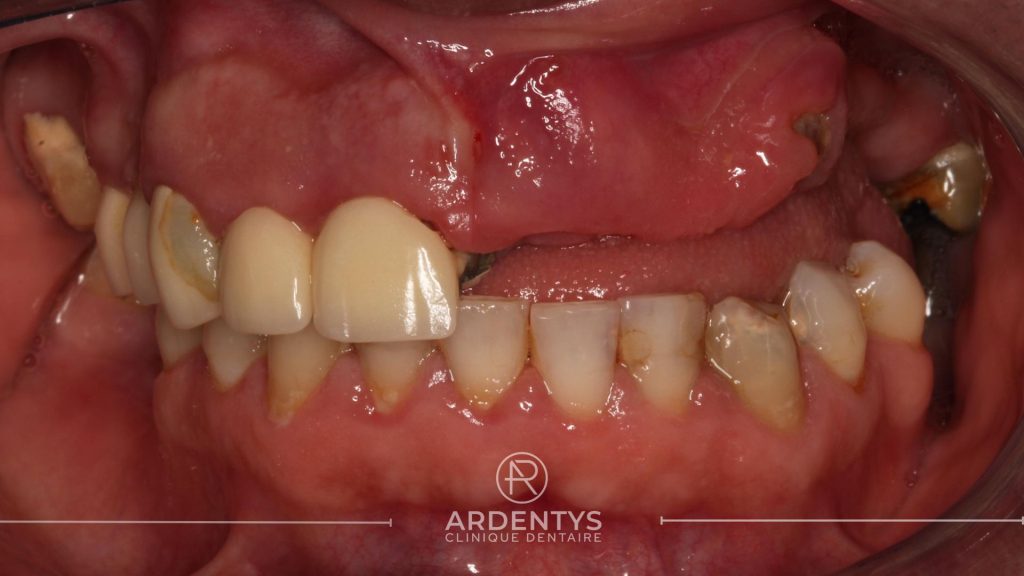 Réhabilitation complète uni maxillaire