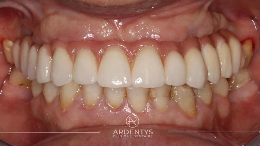 Réhabilitation complète uni maxillaire