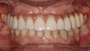 Réhabilitation complète uni maxillaire