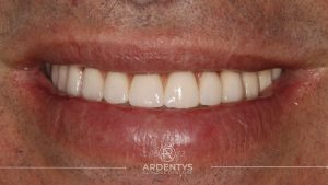 Réhabilitation complète uni maxillaire