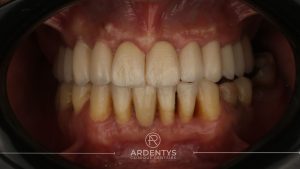 Réhabilitation complète uni maxillaire