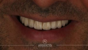 Réhabilitation complète uni maxillaire