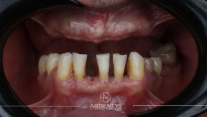 Réhabilitation complète uni maxillaire