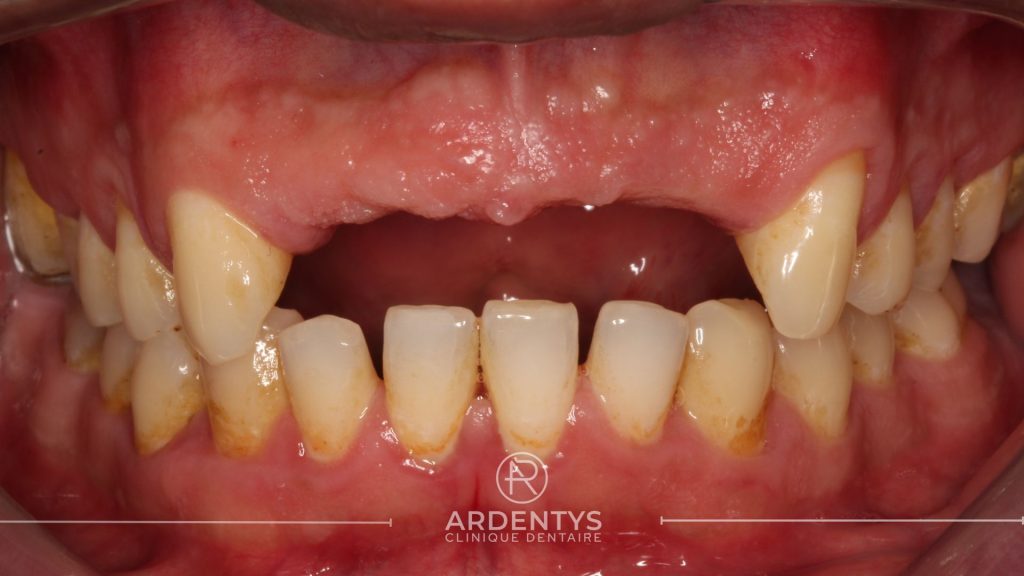 Réhabilitation partielle