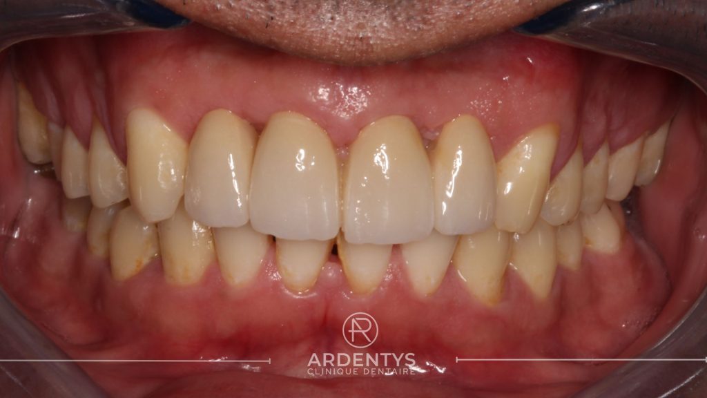 Réhabilitation partielle