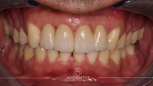 Réhabilitation partielle