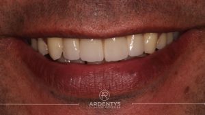 Réhabilitation partielle