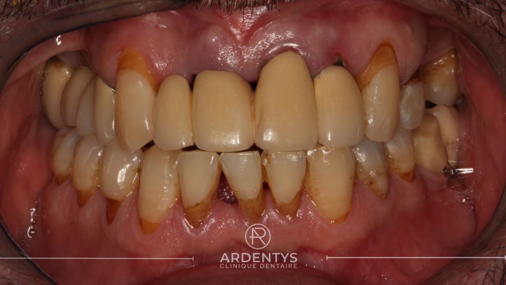 Réhabilitation complète uni maxillaire