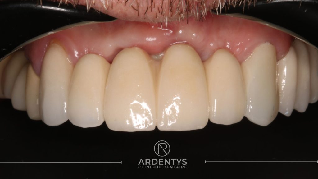 Réhabilitation complète uni maxillaire