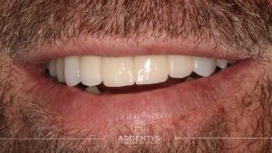 Réhabilitation partielle