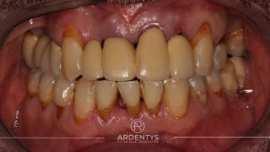 Réhabilitation partielle