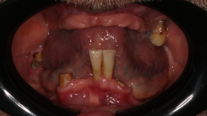 Réhabilitation complète bi maxillaire