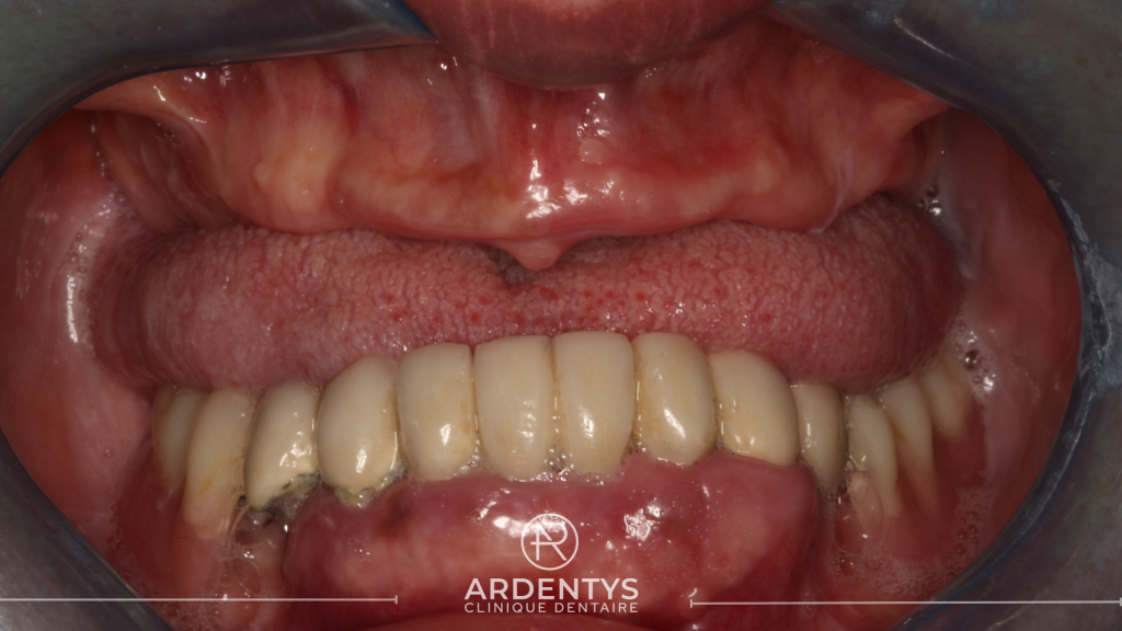 Réhabilitation complète bi maxillaire