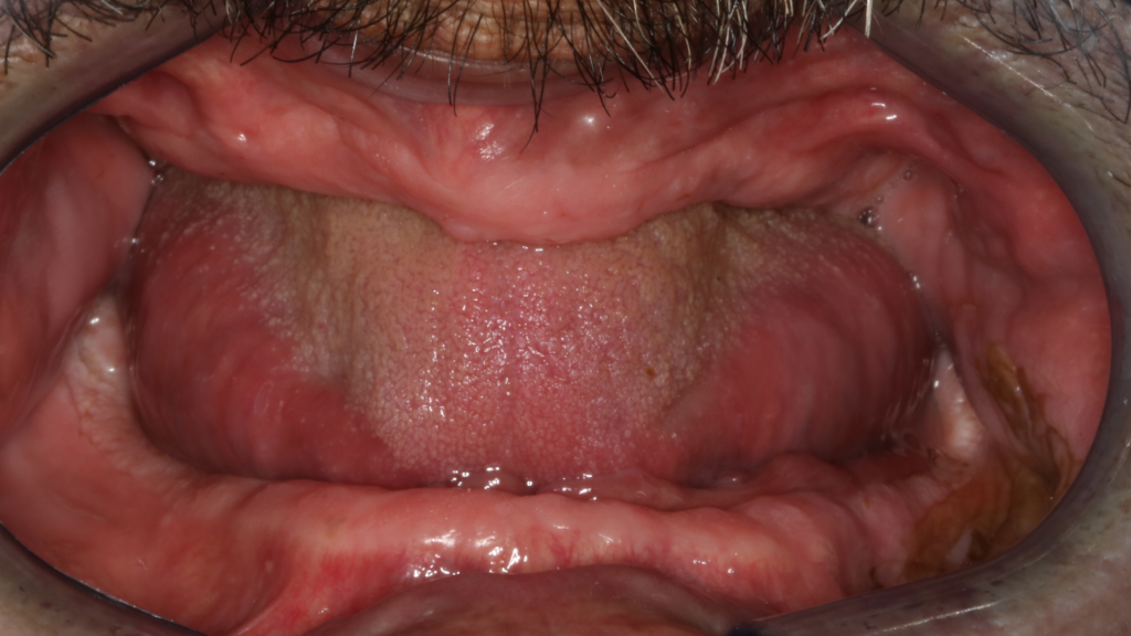 Réhabilitation complète bi maxillaire