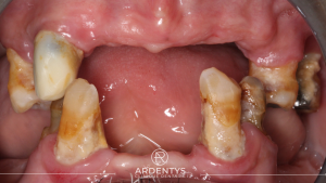Réhabilitation complète bi maxillaire