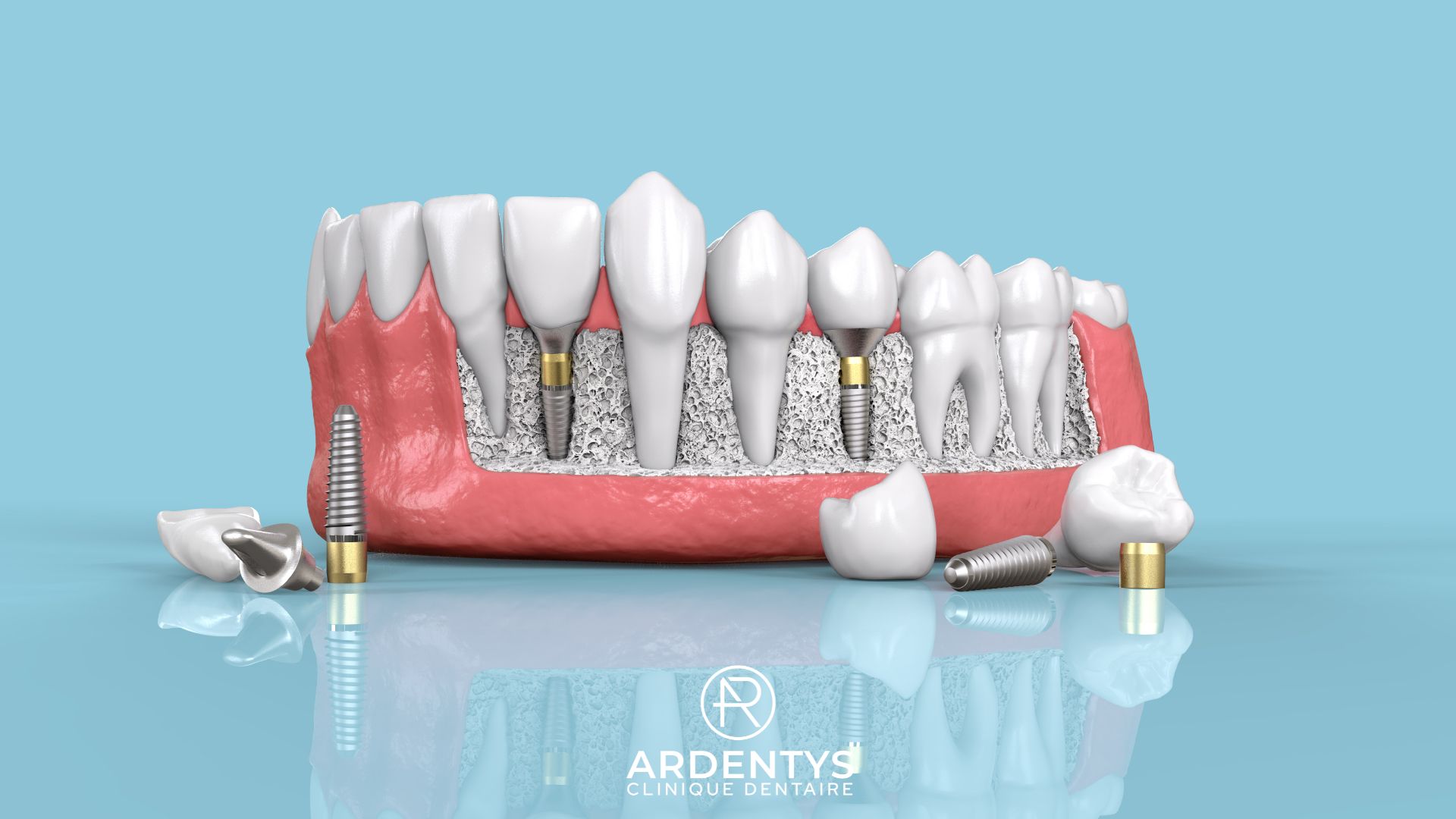 Implants Dentaires : Esthétique et fonction