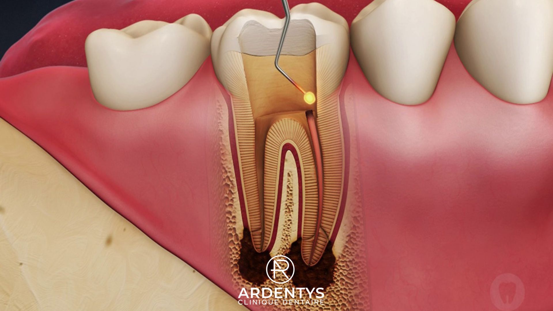 Endodontie : tout savoir sur le traitement des racines