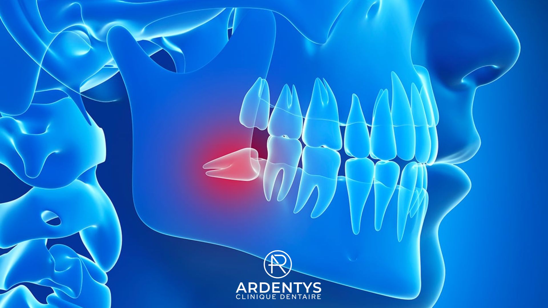 Dents de sagesse : Le guide complet