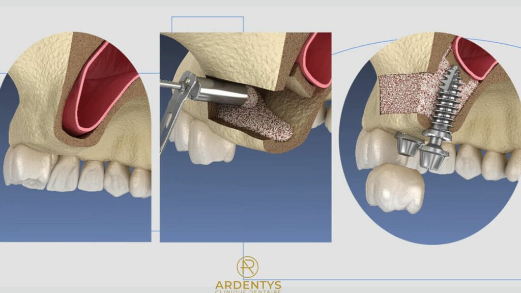 Sinus lift : quand et pourquoi est-il nécessaire ?