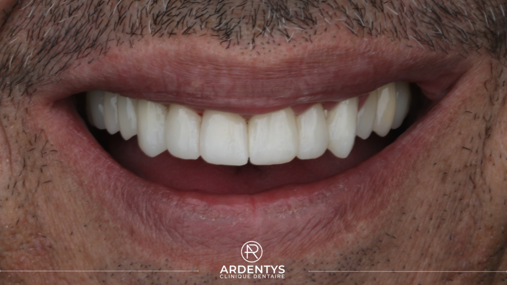 Réhabilitation complète bi maxillaire