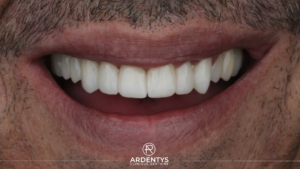 Réhabilitation complète bi maxillaire