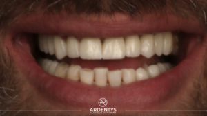 Réhabilitation complète bi maxillaire