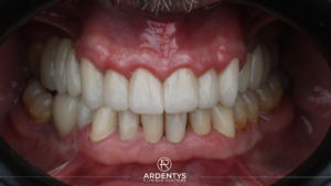 Réhabilitation complète bi maxillaire