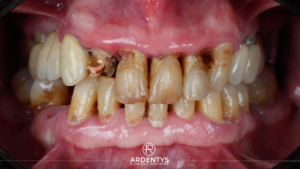 Réhabilitation complète bi maxillaire