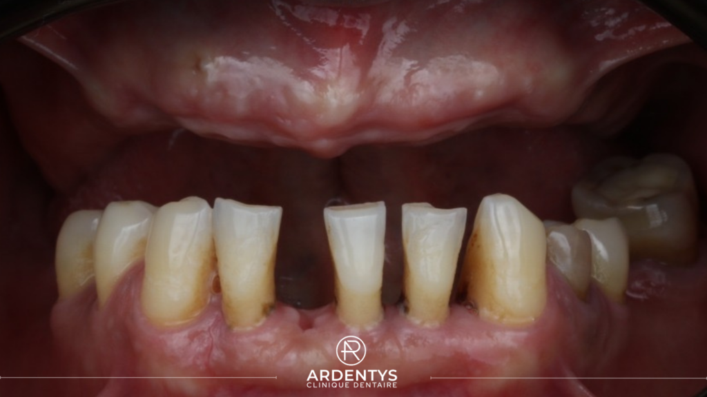 Réhabilitation complète bi maxillaire