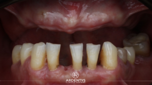 Réhabilitation complète bi maxillaire