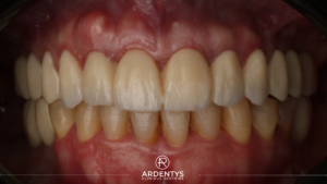 Réhabilitation complète bi maxillaire