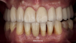 Réhabilitation complète bi maxillaire