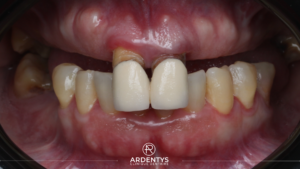 Réhabilitation complète bi maxillaire