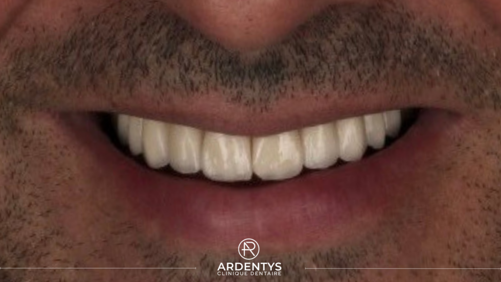 Réhabilitation complète bi maxillaire