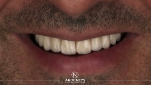 Réhabilitation complète bi maxillaire