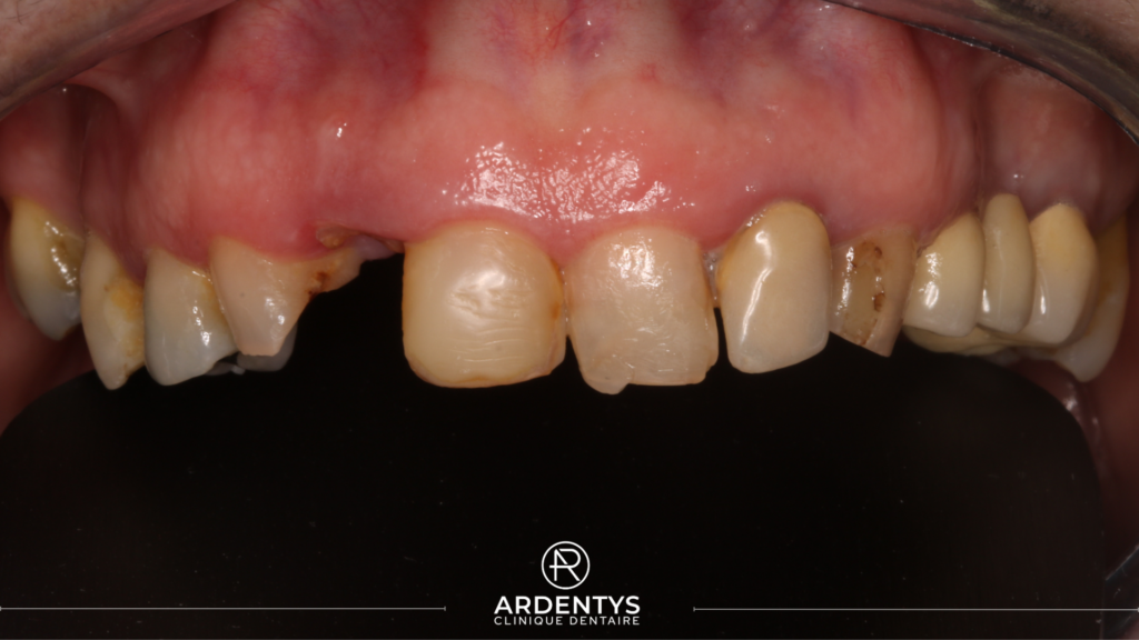 Réhabilitation partielle