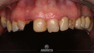 Réhabilitation partielle