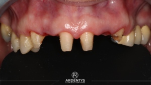 Réhabilitation partielle