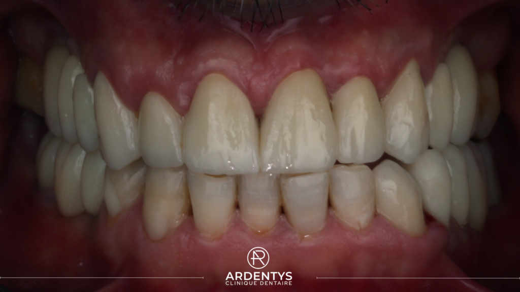 Réhabilitation complète bi maxillaire