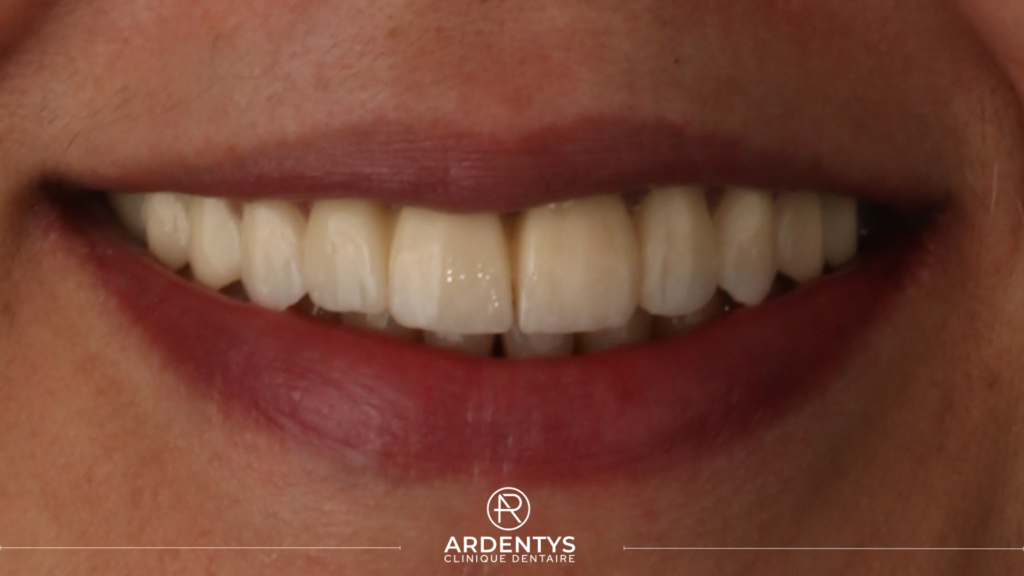 Réhabilitation complète bi maxillaire