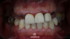 Réhabilitation complète bi maxillaire