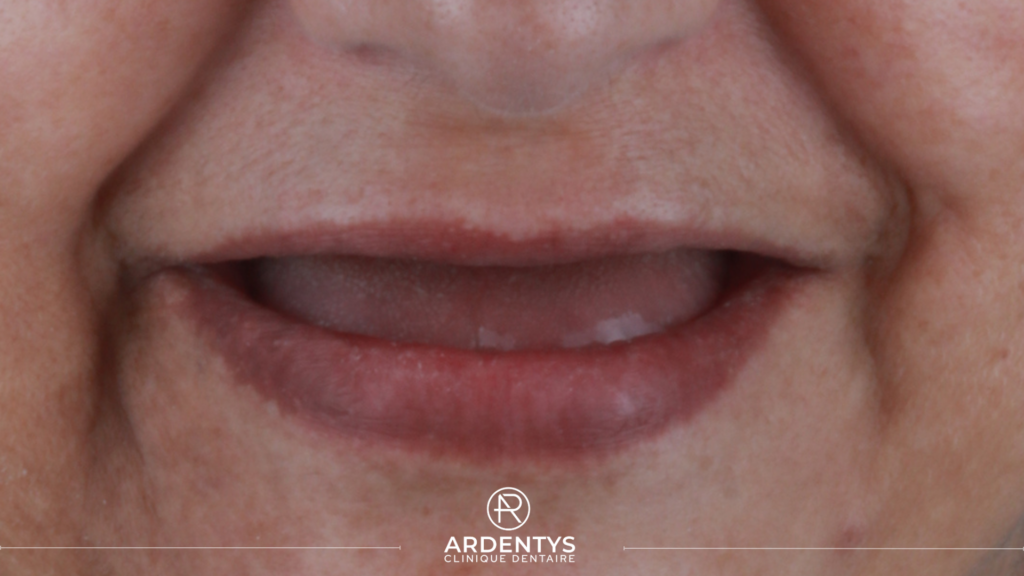 Prothèses Dentaires