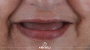 Prothèses Dentaires