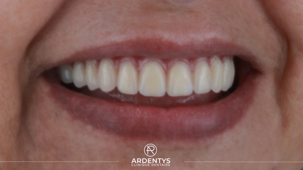 Prothèses Dentaires