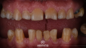 Prothèses Dentaires