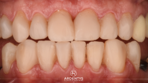 Prothèses Dentaires